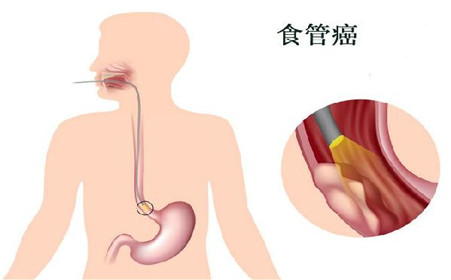 食道癌的癥狀及如何診斷