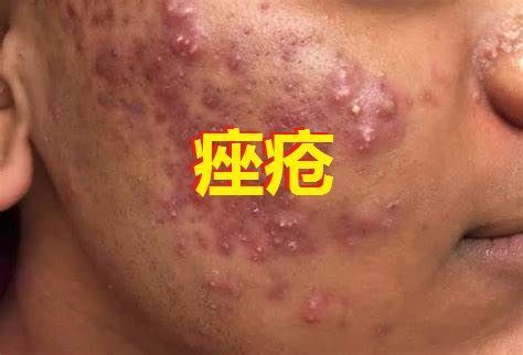 痤瘡新藥局部雄激素抑制劑Winlevi（clascoterone 1%）乳膏劑在美獲批_香港濟民藥業