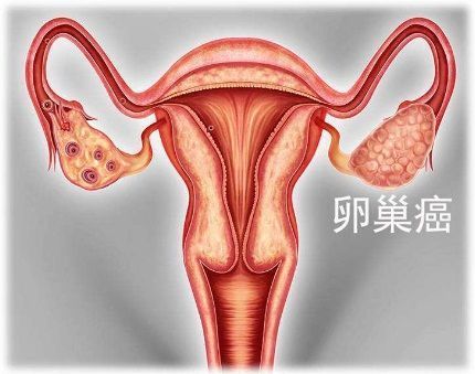Lynparza（利普卓）聯合貝伐單抗一線維持治療同源重組缺陷（HRD）陽性晚期卵巢癌獲歐盟批準！_香港濟民藥業